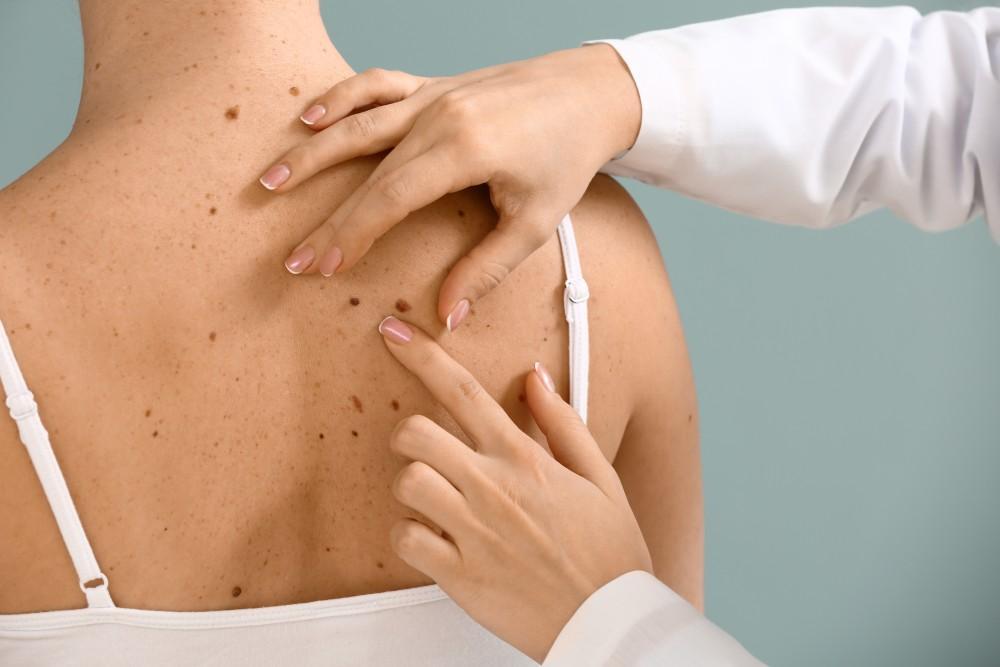 Dermatológ vyšetruje pokožku chrbta a konzultuje možnosti korekcie jaziev alebo odstránenia neestetických výrastkov v ambulancii Renue.